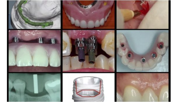 A Z in Restorative Implant Dentistry Series