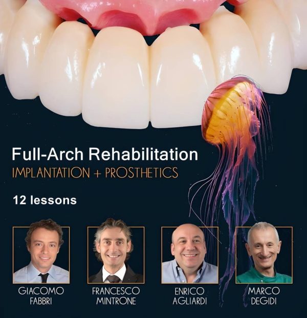 Full Arch Rehabilitation Implantation and Prosthetics fotor 20240624143310 2